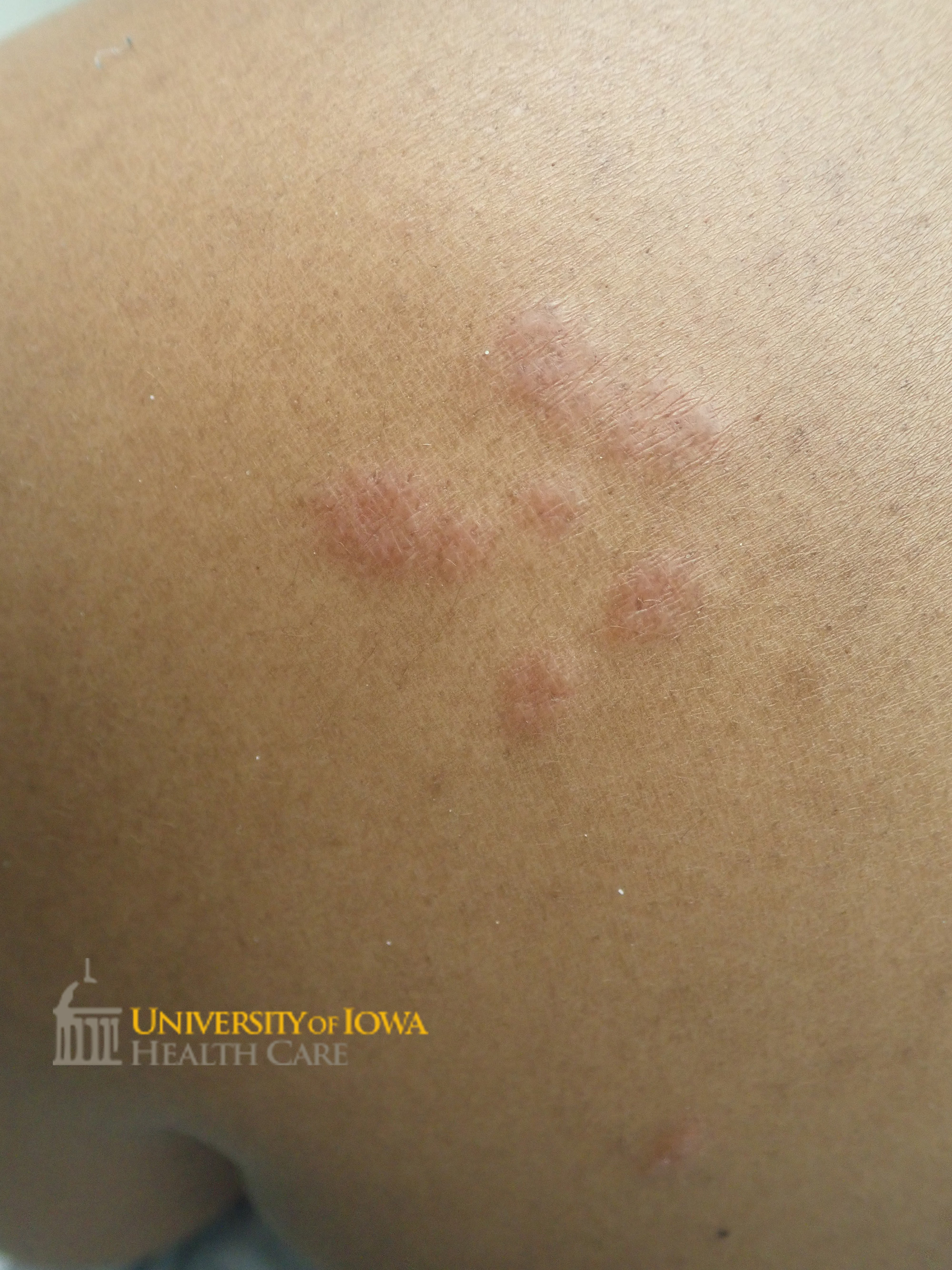Shiny, red-brown clustered papules on the back. (click images for higher resolution).